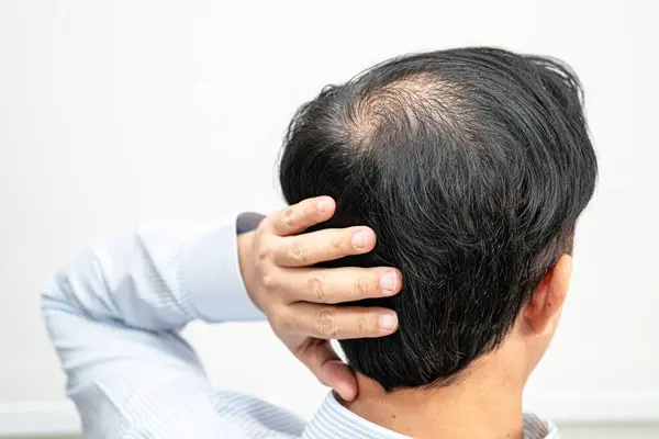Bald Middle Head Begin Loss Hair Glabrous Mature Asian Business — Fotografia de Stock
