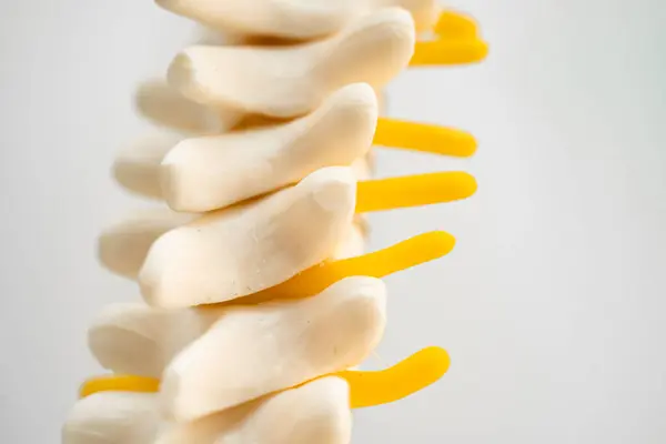 Lendenwirbelsäule Verdrängte Bandscheibenvorfall Spinalnerv Und Knochen Modell Für Die Behandlung Stockbild