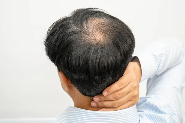 Bald Middle Head Begin Loss Hair Glabrous Mature Asian Business — Fotografia de Stock