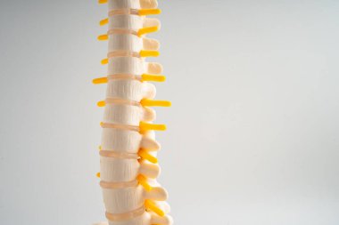 Bel omurgası yerinden oynamış disk parçası, omurilik ve kemik. Ortopedi bölümünde tedavi için model.