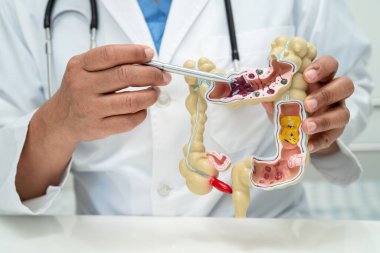 Bağırsak, apandis ve sindirim sistemi, hastanede teşhis ve tedavi için anatomi modelini tutan doktor..