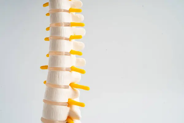 腰椎は関節のディスクの断片 脊髄神経 骨を脱臼させた 整形外科における治療医療モデル ロイヤリティフリーのストック写真