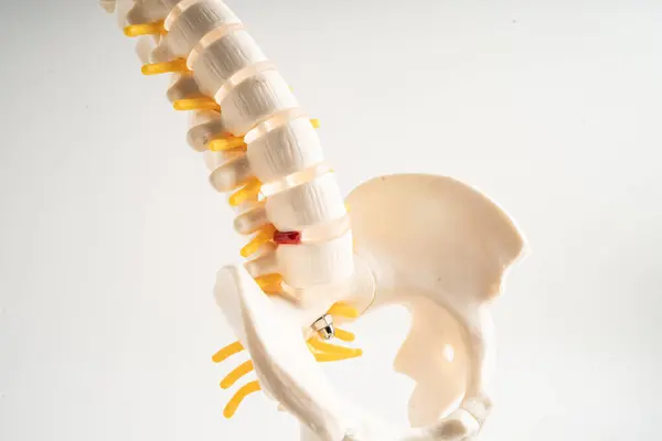 Lumbar Spine Displaced Herniated Disc Fragment Spinal Nerve Bone Model Royalty Free Stock Images