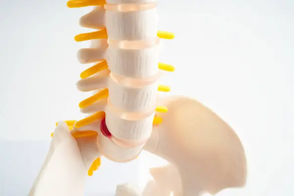 腰椎は関節のディスクの断片 脊髄神経 骨を脱臼させた 整形外科における治療医療モデル ストック写真