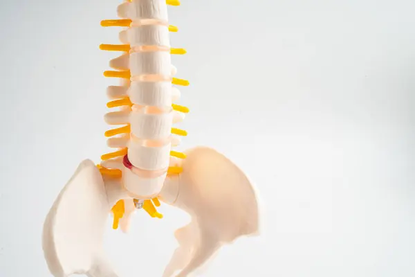 Lumbar Spine Displaced Herniated Disc Fragment Spinal Nerve Bone Model Stock Image