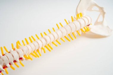 Bel omurgası yerinden oynamış disk parçası, omurilik ve kemik. Ortopedi bölümünde tedavi için model.