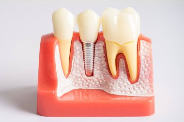 Diş implantı, çeneye yapay diş kökleri, diş tedavisinin kök kanalı, diş eti hastalığı, diş hekimliği üzerine çalışan dişçi modeli.