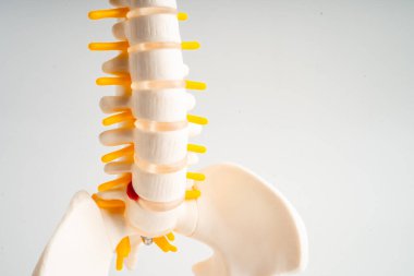 Bel omurgası yerinden oynamış disk parçası, omurilik ve kemik. Ortopedi bölümünde tedavi için model.