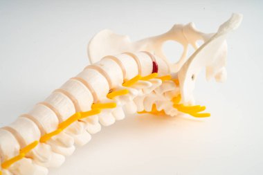 Bel omurgası yerinden oynamış disk parçası, omurilik ve kemik. Ortopedi bölümünde tedavi için model.