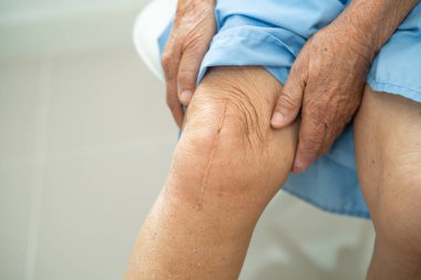 Asyalı yaşlı kadın hasta yaralarını gösteriyor. Diz eklemi değiştirilmiş. Hastanede yatakta eklem ameliyatı geçirmiş..