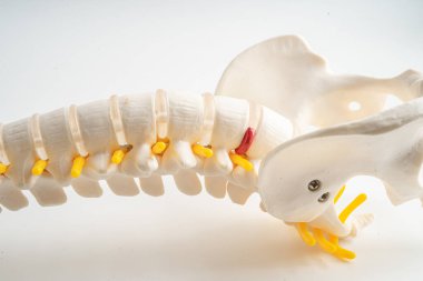 Bel omurgası yerinden oynamış disk parçası, omurilik ve kemik. Ortopedi bölümünde tedavi için model.