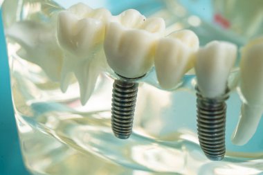Diş implantı, çeneye yapay diş kökleri, diş tedavisinin kök kanalı, diş eti hastalığı, diş hekimliği üzerine çalışan dişçi modeli.