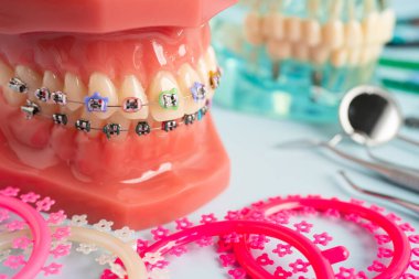 Orthodontic ligatures rings and ties, elastic rubber bands on orthodontic braces, model for dentist studying about dentistry. clipart