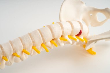 Bel omurgası yerinden oynamış disk parçası, omurilik ve kemik. Ortopedi bölümünde tedavi için model.