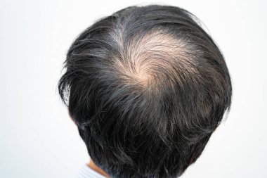 Bald in the middle head and begin no loss hair glabrous of mature Asian business smart active office man.