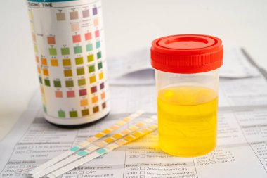 İdrar tahlili, reaksiyonlu idrar kabı. PH kağıt testi ve karşılaştırma tablosu laboratuvarda..