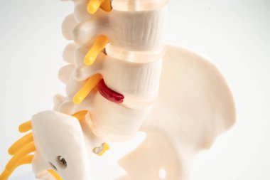 Bel omurgası yerinden oynamış disk parçası, omurilik ve kemik. Ortopedi bölümünde tedavi için model.