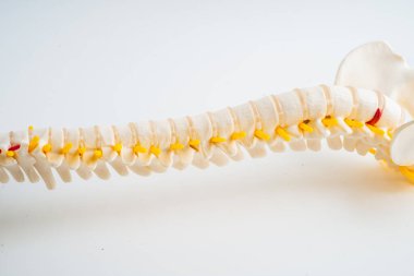 Bel omurgası yerinden oynamış disk parçası, omurilik ve kemik. Ortopedi bölümünde tedavi için model.