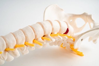 Bel omurgası yerinden oynamış disk parçası, omurilik ve kemik. Ortopedi bölümünde tedavi için model.