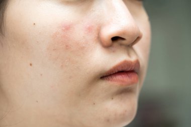 Asian young with pimple, acne, scar on skin, facial problem.