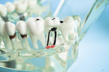 Diş implantı, çeneye yapay diş kökleri, diş tedavisinin kök kanalı, diş eti hastalığı, diş hekimliği üzerine çalışan dişçi modeli.