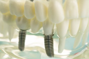 Diş implantı, çeneye yapay diş kökleri, diş tedavisinin kök kanalı, diş eti hastalığı, diş hekimliği üzerine çalışan dişçi modeli.