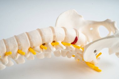 Bel omurgası yerinden oynamış disk parçası, omurilik ve kemik. Ortopedi bölümünde tedavi için model.