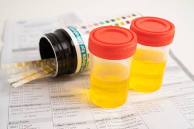 İdrar tahlili, reaksiyonlu idrar kabı. PH kağıt testi ve karşılaştırma tablosu laboratuvarda..