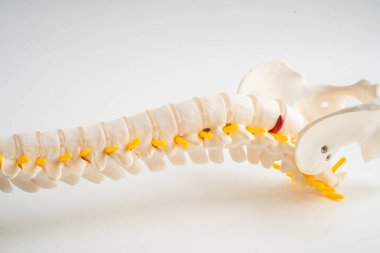 Bel omurgası yerinden oynamış disk parçası, omurilik ve kemik. Ortopedi bölümünde tedavi için model.