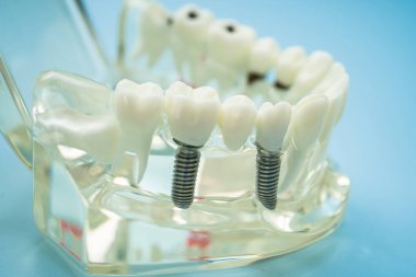 Diş implantı, çeneye yapay diş kökleri, diş tedavisinin kök kanalı, diş eti hastalığı, diş hekimliği üzerine çalışan dişçi modeli.