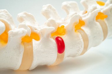Bel omurgası yerinden oynamış disk parçası, omurilik ve kemik. Ortopedi bölümünde tedavi için model.