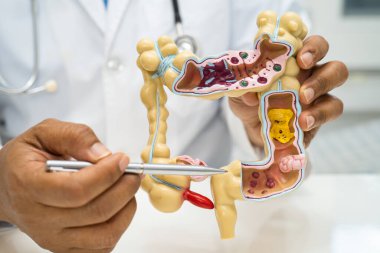 Bağırsak, apandis ve sindirim sistemi, hastanede teşhis ve tedavi için anatomi modelini tutan doktor..