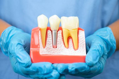 Diş implantı tutan Asyalı dişçi, çeneye yapay diş kökleri, diş tedavisi kanal tedavisi, diş eti hastalığı, dişçi modeli.