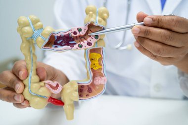 Bağırsak, apandis ve sindirim sistemi, hastanede teşhis ve tedavi için anatomi modelini tutan doktor..
