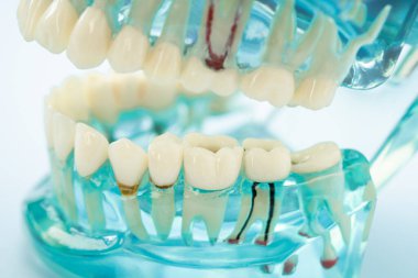 Diş implantı, çeneye yapay diş kökleri, diş tedavisinin kök kanalı, diş eti hastalığı, diş hekimliği üzerine çalışan dişçi modeli.