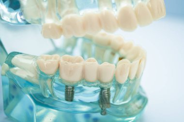 Diş implantı, çeneye yapay diş kökleri, diş tedavisinin kök kanalı, diş eti hastalığı, diş hekimliği üzerine çalışan dişçi modeli.