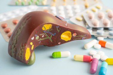 Hap tedavisi gören karaciğer modeli, siroz, karaciğer kanseri, yağlı karaciğer..