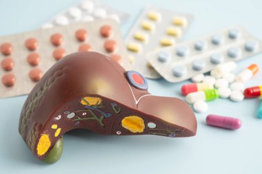 Hap tedavisi gören karaciğer modeli, siroz, karaciğer kanseri, yağlı karaciğer..