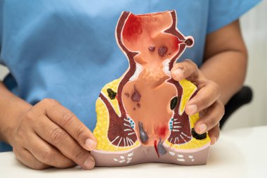 Hastanede rektum ve hemoroit insan anatomisi modeli olan Asyalı bir doktor vasküler yapısında iltihaplanma var..