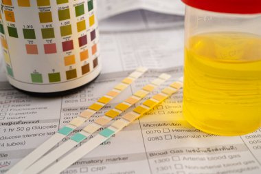 İdrar tahlili, reaksiyonlu idrar kabı. PH kağıt testi ve karşılaştırma tablosu laboratuvarda..