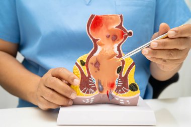 Hastanede rektum ve hemoroit insan anatomisi modeli olan Asyalı bir doktor vasküler yapısında iltihaplanma var..