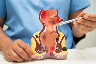 Hastanede rektum ve hemoroit insan anatomisi modeli olan Asyalı bir doktor vasküler yapısında iltihaplanma var..