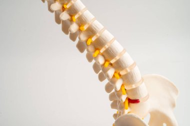 Bel omurgası yerinden oynamış disk parçası, omurilik ve kemik. Ortopedi bölümünde tedavi için model.