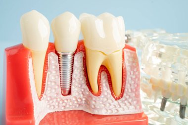 Diş implantı, çeneye yapay diş kökleri, diş tedavisinin kök kanalı, diş eti hastalığı, diş hekimliği üzerine çalışan dişçi modeli.