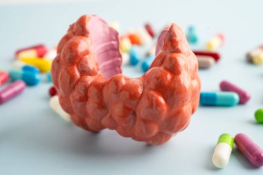 İlaç tedavisi gören tiroid modeli, Hipertiroidizm, Aşırı Aktif veya Lenfoma.