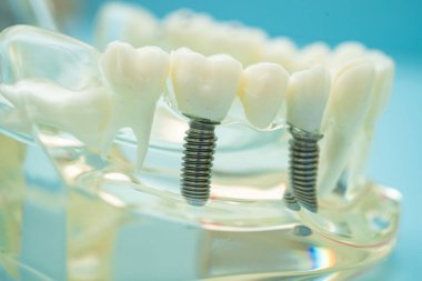 Diş implantı, çeneye yapay diş kökleri, diş tedavisinin kök kanalı, diş eti hastalığı, diş hekimliği üzerine çalışan dişçi modeli.