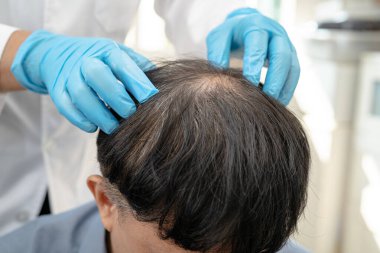 Doktor check-up ve tedavi Asyalı adam kellik saç problemi olan hasta.