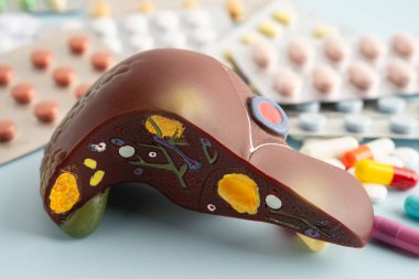 Hap tedavisi gören karaciğer modeli, siroz, karaciğer kanseri, yağlı karaciğer..