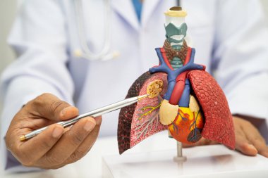 Zatürree, akciğer kanseri, Asyalı doktor hastanede teşhis ve tedavi için insan anatomisi modeli tutuyor.