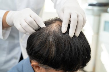 Doktor check-up ve tedavi Asyalı adam kellik saç problemi olan hasta.